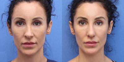 Woman treated with Revision Rhinoplasty - Woman treated with Revision Rhinoplasty