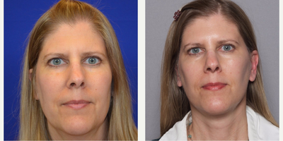 55-64 year old woman treated with Facelift - Facelift