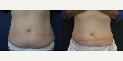 35-44 year old woman treated with CoolSculpting - Elite Freeze powered by Cool Sculpting