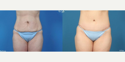Woman treated with Tummy Tuck - Woman treated with Tummy Tuck