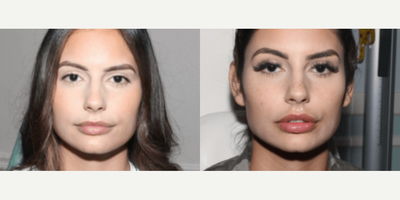 25-34 year old woman treated with Silikon 1000 - 25-34 year old woman treated with Silikon 1000
