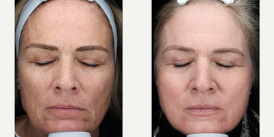 55-64 year old woman treated with ProFractional Laser - Sciton Profractional