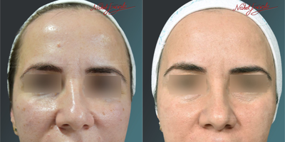 35-44 Years Old Woman Treated with Mole Removal - A general scan was realized on the face of our female patient. In addition to that, thanks for the mole removal treatment; because, she got rid of from the spots on her face and the mole, which is located on her forehead area.