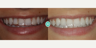 Woman treated with Dental Implants - Woman treated with Dental Implants