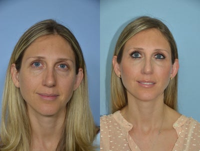 Fat Transfer to Face - 37 year old female who is 3 months after undergoing a transfer to the face; specifically to the temporal gulf, supraorbital rim, infraorbital rim, as well as the cheeks.