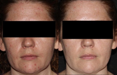 37 Year Old Female Treated for Acne and Post-Inflammatory Hyperpigmentation - Status post 4 Genesis treatments