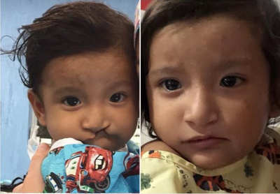 Man treated with Cleft Lip And Palate Repair - Man treated with Cleft Lip And Palate Repair