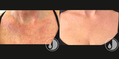55-64 year old woman treated with Lumecca - IPL to decollate