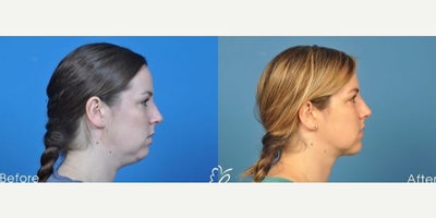 Woman treated with Vaser Liposuction - This patient underwent VASER liposuction of the submental area and fat grafting to the chin.