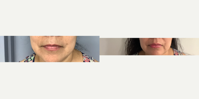 45-54 year old woman treated with Dermal Fillers, Lip Fillers, Cheek Fillers, RHA Collection Fillers - Did half a syringe of 4 rha on each cheek for total of 1 syringe total on both cheeks and lip only rha 2 for a total of 1 RHA 2 syringe
