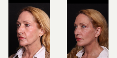 55-64 year old woman treated with Facelift, Eyelid Surgery, Double Eyelid Surgery, Brow Lift, Neck Lift, Facial Fat Transfer - Deep plane facelift, necklift, fat transfer, quad blepharoplasty B&A.