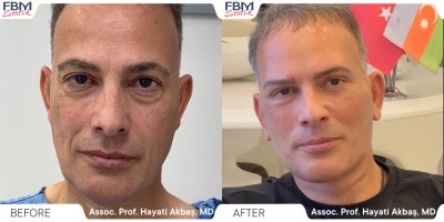 45-54 year old man treated with Facelift, Facial Fat Transfer, Eyelid Surgery - 45-54 year old man treated with Facelift, Facial Fat Transfer, Eyelid Surgery