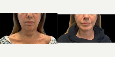 65-74 year old woman treated with Deep Plane Facelift, Facelift, Lower Facelift, SMAS Facelift, Neck Lift - Procedures:Exteneded deep plane faceliftDeep necklift
