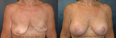 Breast Implant Revision - This patient had ruptured implant and underwent Breast Implant Revision with Dr. Reza Sadrian.