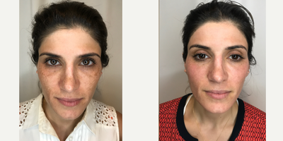 35-44 year old woman treated with Pico Genesis - 35-44 year old woman treated with Pico Genesis