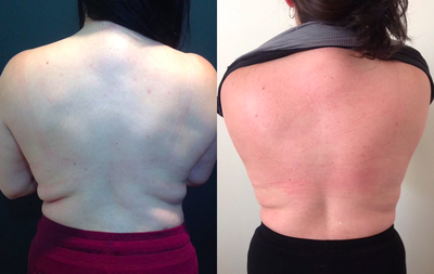 45-54 year old woman treated with SculpSure - SculpSure treatment of flanks, after 2 treatments.
