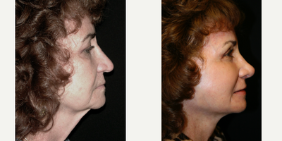 55-64 year old woman treated with Deep Plane Facelift, Facial Fat Transfer, Laser Resurfacing, Rhinoplasty, Lip Repositioning - This patient had total facial rejuvenation .