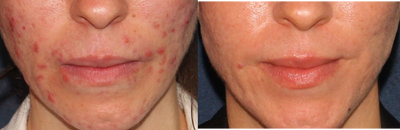 18-24 year old woman treated with Photodynamic Therapy - Photodynamic Therapy treatments to address acne and then one Fraxel Restore to address acne scars.