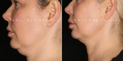45-54 year old woman treated with Sofwave, Kybella, Neck Lift, Cheek Lift, Nonsurgical Facelift, Skin Tightening, Nonsurgical Ne - 10 Weeks Post Miria Neck, Sofwave Cheeks & 26 Weeks Post KybellaAbove patient received a combination of treatments demonstrating impressive results for non-surgical skin tightening, lifting, and contouring. At 10 weeks post-Miria treatment on the neck, there's a visible improvement in skin firmness, helping to reduce sagging and enhance neck contours. Additionally, Sofwave applied to the cheeks delivers a lifting effect, smoothing and refreshing the mid-face for a naturally rejuvenated look. Kybella treatment treatment resulted in a more defined jawline and reduced submental fullness, as Kybella targets and dissolves excess fat under the chin. Together, these treatments worked synergistically, using advanced technology to achieve a lifted, sculpted, and refreshed appearance without the need for surgery.