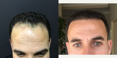 35-44 year old man treated with Hair Transplant - Sapphire FUE Hair Transplant / Dr ArslanHere 6 months post-op of our patient from Belgium.2700 Grafts