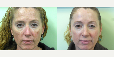 50 year old woman treated with a Vi Peel and IPL - This patient was concerned with sun damaged skin. She had 1 ViPeel and an IPL 2 months later.