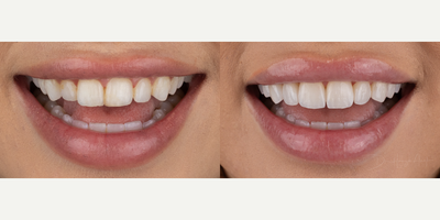 25-34 year old woman treated with Lumineers - Natural, form fitting and individually crafted porcelain veneers for our amazing patient.