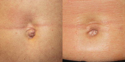 25-34 year old woman treated with Belly Button Surgery - Belly Button Surgery (Umbilicoplasty) is a procedure that changes the shape and appearance of the belly button.