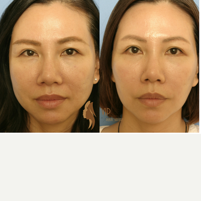 45-54 year old woman treated with EndyMed 3Deep - This is the Endymed Intensif (RF skin tightening) with PRP(Platelet Rich Plasma) procedure after 4 weeks.The patients has greatly improved her skin quality(including skin pores) and has tightened her facial skin. Combining procedures works synergistically and is very convenient because two procedures can be performed at the same time. It works really well for someone who is looking for facial improvement but is not ready for an invasive procedure..