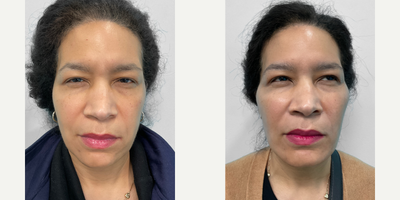45-54 year old woman treated with Dermal Fillers, Chin Filler - This woman in her early fifties wanted to enhance the appearance of her cheeks and fine lines and wrinkles.  Our nurse injector, Heather, treated her glabella and forehead with dysport, her midface with Voluma, and her jawline with Volux.