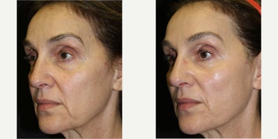 Woman treated with Thread Lift, Contour Thread Lift - Woman treated with Thread Lift, Contour Thread Lift