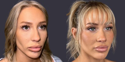 25-34 year old woman treated with Eyelid Surgery, CO2 Laser, ActiveFX - This 30 year old woman is 5'5 and 135 pounds. She presented requesting an eyelid lift. She had an upper eyelid blepharoplasty and and CO2 laser resurfacing of her lower eyelids and crows feet area.