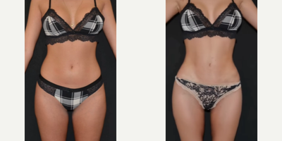 Woman treated with Power-Assisted Liposuction (PAL), Liposculpture - When diet and exercise fail to yield the results you desire and you start to feel demotivated, the PAL HIGH Definition Liposculpture is the solution you are looking for.