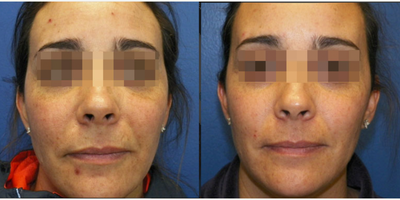 Woman treated with SmartSkin CO2 laser - Woman treated with SmartSkin CO2 laser