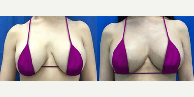 Woman treated with Breast Implant Revision - Woman treated with Breast Implant Revision through implant exchangeas well as Breast Reduction