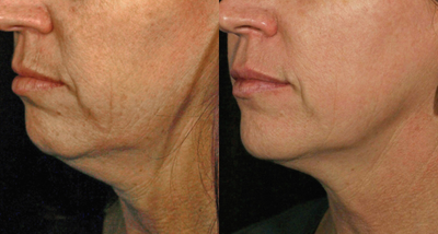 55-64 year old woman treated with Skintyte - 1 year after 5 treatments SkinTyte