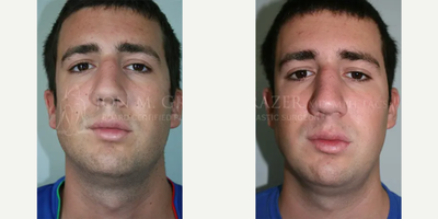 Man treated with Mole Removal - Man treated with Mole Removal