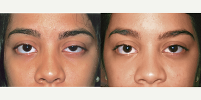 25 year old woman treated with Ptosis Surgery - 25 year old woman who had Ptosis Repa