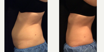 25-34 year old woman treated with CoolSculpting - 25-34 year old woman treated with CoolSculpting on abdomen.