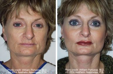 Cheek and Chin Implants, Neck Lift - Cheek and Chin Implants, Neck Lift