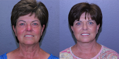 55-64 year old woman treated with Lifestyle Lift - Patient had Lifestyle Lift, Fat Transfer, Upper and Lower Bleph