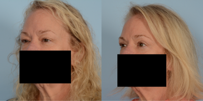 45-54 year old woman treated with Eyelid Surgery - Upper Blepharoplasty