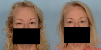 45-54 year old woman treated with Eyelid Surgery - Upper Blepharoplasty