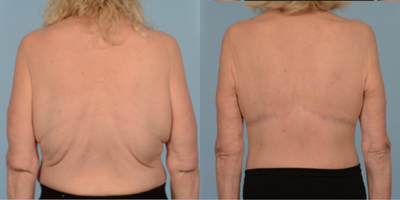 45-54 year old woman treated with Back Lift - Upper Back Lift
