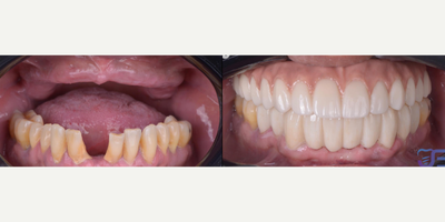 Person treated with Dental Bridge, All-on-4 Dental Implants - Person treated with Dental Bridge, All-on-4 Dental Implants