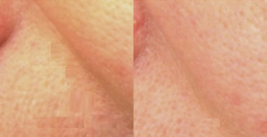 Woman treated with Pelleve - Woman treated with Pelleve