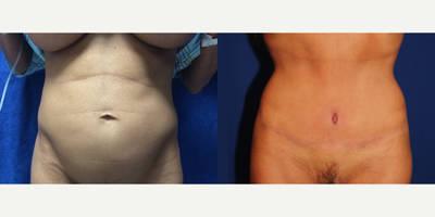 35-44 year old woman treated with Mini Tummy Tuck - The 50-year-old patient underwent a mini tummy tuck. This is her after a couple of months.