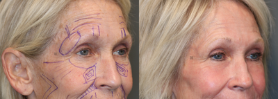 CO2 Laser and Stem Cell Fat Transfer - Laser resurfacing with fractionated CO2 and stem cell fat transfer.