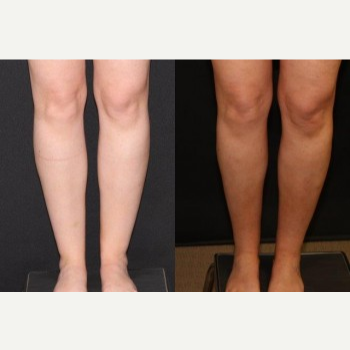 Liposuction of the Knees, Calves, and Ankles - Liposuction of the Knees, Calves, and Ankles