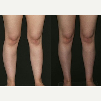 Liposuction of the Knees, Calves, and Ankles - Liposuction of the Knees, Calves, and Ankles