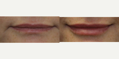 45-54 year old woman treated with Lip Augmentation - 45-54 year old woman treated with Lip Augmentation